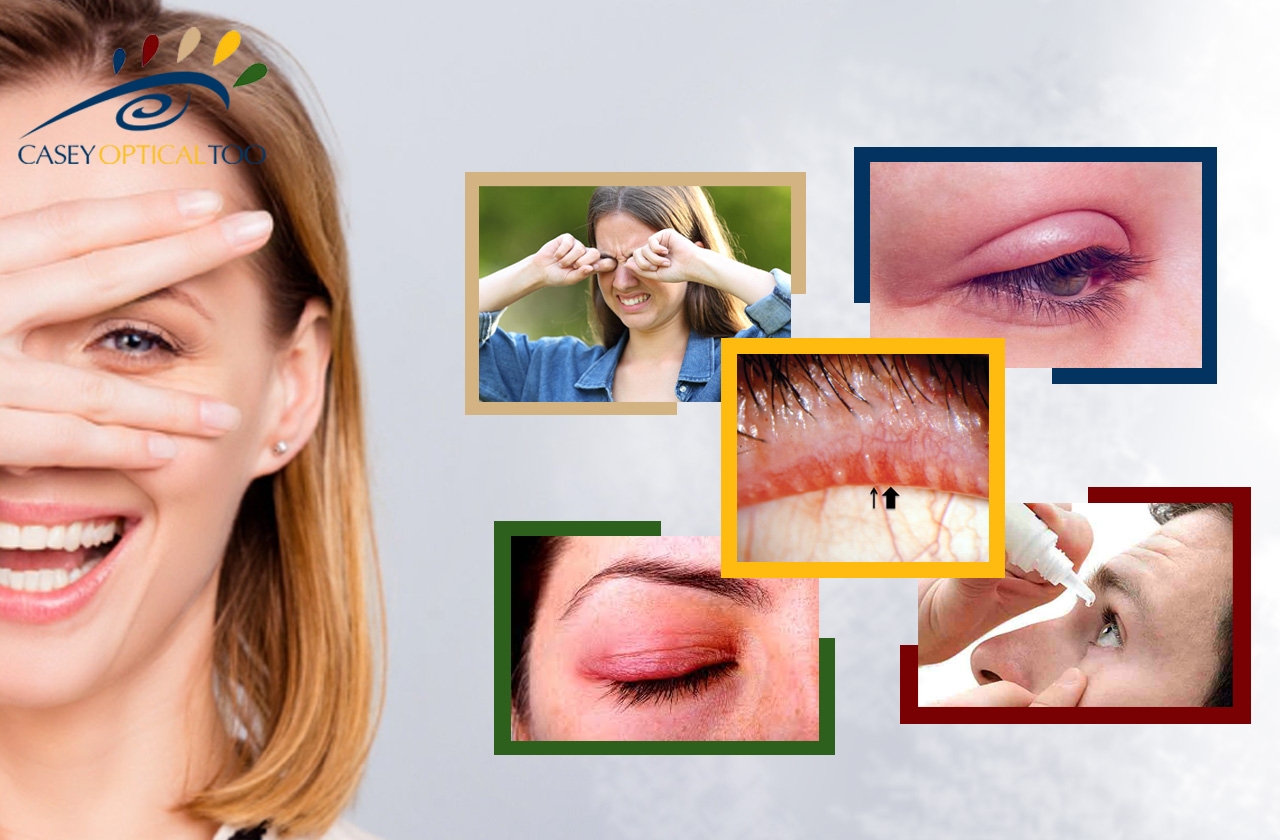 Causes of Swollen Eyelids and Hygiene Advice for Those Suffering Blepharitis