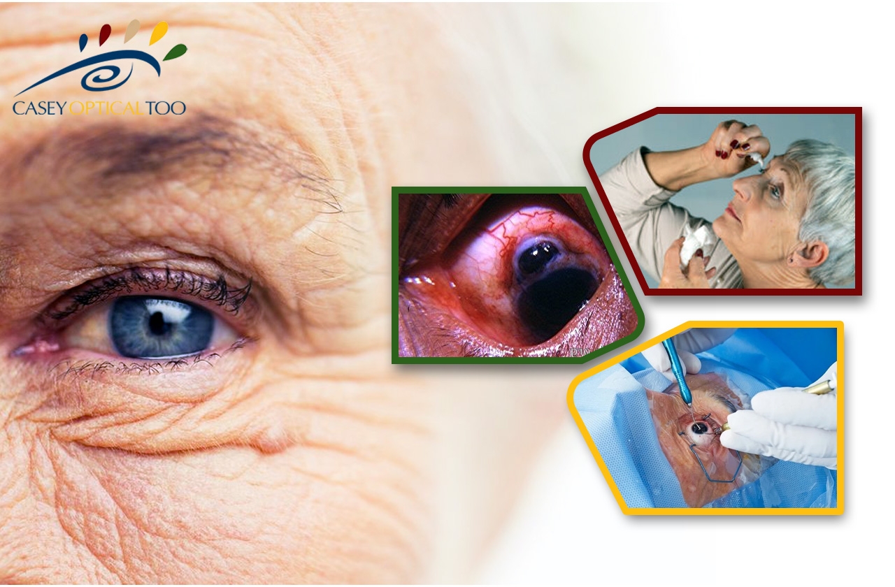 Unveiling the Reality: Cataract Surgery Complications and Their Management